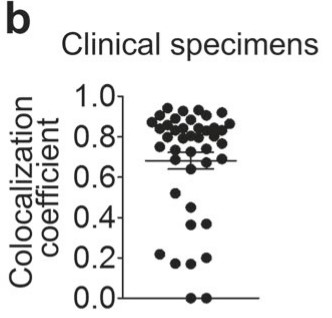 Manders coefficient of LSECtin and CD68 in clinical tumor sections.jpg